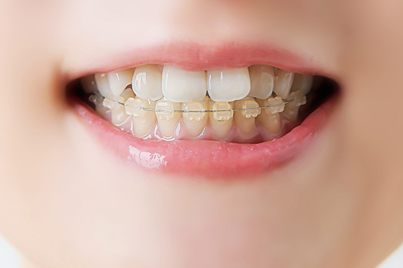 写真：矯正歯科のイメージ